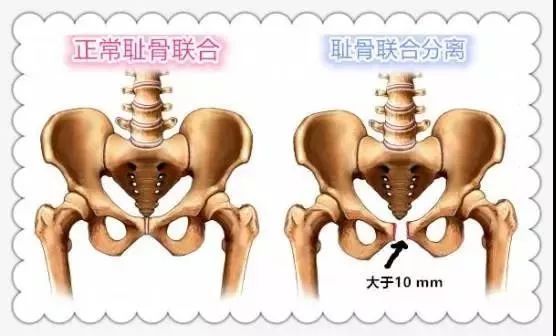 产后耻骨联合分离疼痛康复方法与预防方法 (图1)